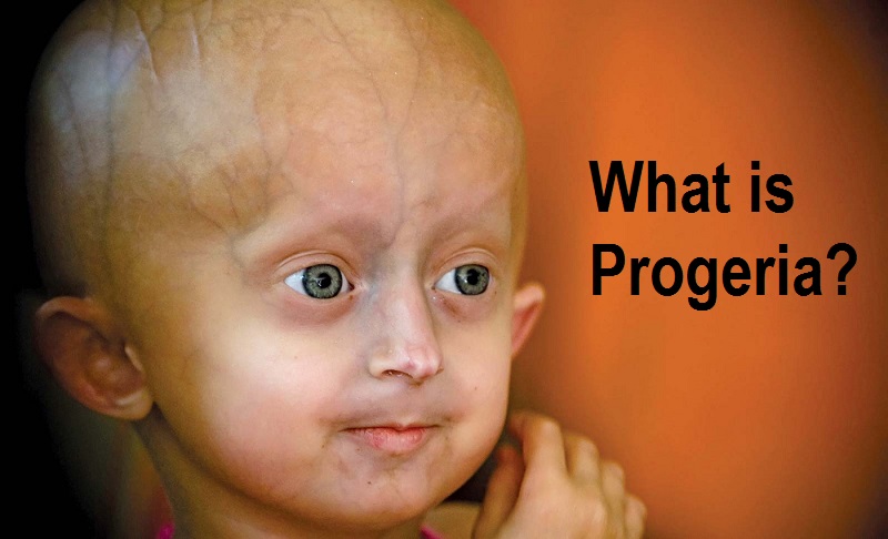 What is progeria
